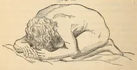 An illustration from The American journal of the medical sciences (1827)