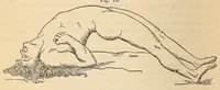 An illustration from The American journal of the medical sciences (1827)