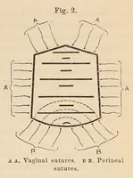 Picture 2 of 18 from The American journal of the medical sciences (1827), leaf 51