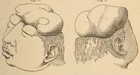 An illustration from The American journal of the medical sciences (1827)