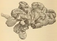An illustration from The American journal of the medical sciences (1827)