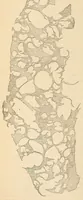 Picture 5 of 9 from The American journal of the medical sciences (1827), leaf 152