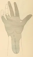 An illustration from The American journal of the medical sciences (1827)