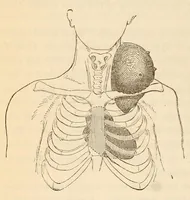 An illustration from The American journal of the medical sciences (1827)