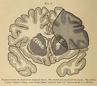 Picture 9 of 15 from The American journal of the medical sciences (1827), leaf 432