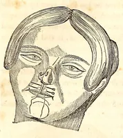 An illustration from The American journal of the medical sciences (1827)