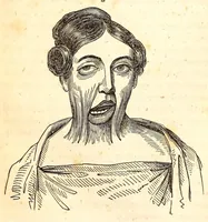 An illustration from The American journal of the medical sciences (1827)
