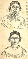An illustration from The American journal of the medical sciences (1827)
