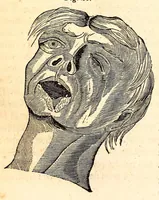An illustration from The American journal of the medical sciences (1827)