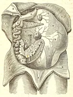 An illustration from The American journal of the medical sciences (1827)