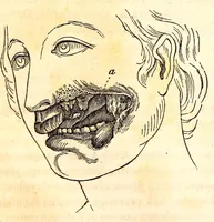 An illustration from The American journal of the medical sciences (1827)