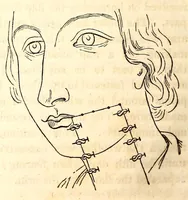 An illustration from The American journal of the medical sciences (1827)