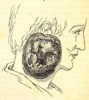An illustration from The American journal of the medical sciences (1827)
