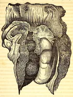 An illustration from The American journal of the medical sciences (1827)