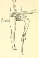 An illustration from The American journal of the medical sciences (1827)