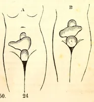 Picture 14 of 17 from The American journal of the medical sciences (1827), leaf 365