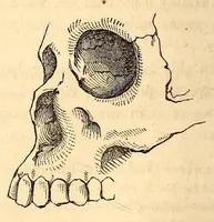 An illustration from The American journal of the medical sciences (1827)