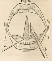 An illustration from The American journal of the medical sciences (1827)
