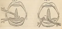 Picture 3 of 13 from The American journal of the medical sciences (1827), leaf 79