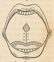 An illustration from The American journal of the medical sciences (1827)