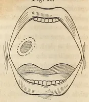 Picture 8 of 13 from The American journal of the medical sciences (1827), leaf 90