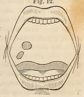 Picture 9 of 13 from The American journal of the medical sciences (1827), leaf 91