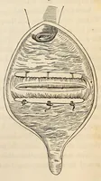 An illustration from The American journal of the medical sciences (1827)