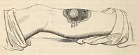 An illustration from The American journal of the medical sciences (1827)