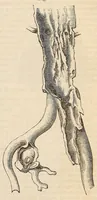 An illustration from The American journal of the medical sciences (1827)