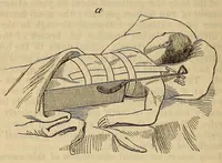 An illustration from The American journal of the medical sciences (1827)