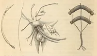 An illustration from The American journal of the medical sciences (1827)