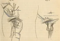 An illustration from The American journal of the medical sciences (1827)