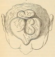Picture 3 of 7 from The American journal of the medical sciences (1827), leaf 100