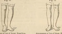 An illustration from The American journal of the medical sciences (1827)