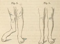 An illustration from The American journal of the medical sciences (1827)