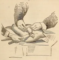 An illustration from The American journal of the medical sciences (1827)