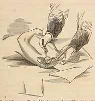 An illustration from The American journal of the medical sciences (1827)
