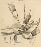 Picture 6 of 8 from The American journal of the medical sciences (1827), leaf 315
