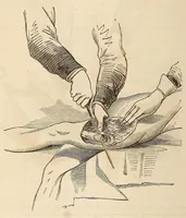 Picture 7 of 8 from The American journal of the medical sciences (1827), leaf 316
