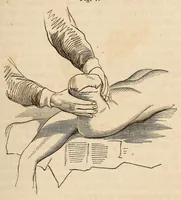 An illustration from The American journal of the medical sciences (1827)