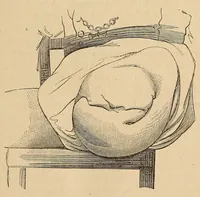 An illustration from The American journal of the medical sciences (1827)