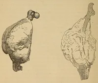 An illustration from The American journal of the medical sciences (1827)