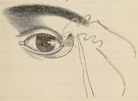 An illustration from The American journal of the medical sciences (1827)