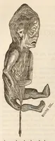 An illustration from The American journal of the medical sciences (1827)