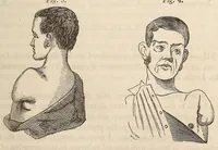 An illustration from The American journal of the medical sciences (1827)