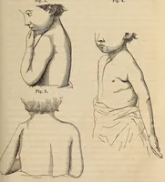 An illustration from The American journal of the medical sciences (1827)