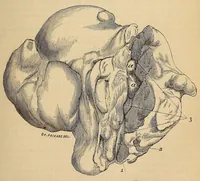 Picture 4 of 17 from The American journal of the medical sciences (1827), leaf 115