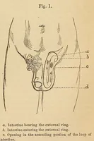 Picture 15 of 17 from The American journal of the medical sciences (1827), leaf 411