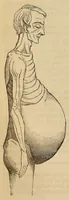 Picture 9 of 17 from The American journal of the medical sciences (1827), leaf 134