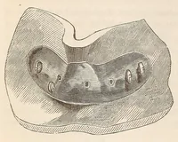 Picture 14 of 14 from The American journal of the medical sciences (1827), leaf 422